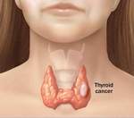 В США растет заболеваемость раком щитовидной железы