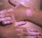 Больные витилиго обладают повышенной устойчивостью к развитию рака кожи