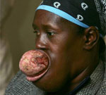 Хирургам  понадобились почти  сутки, чтобы удалить  изо рта жительницы Гаити опухоль  весом около 2 килограммов