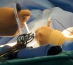 Ученые изобрели быстрый метод определения начала отторжения пересаженного органа