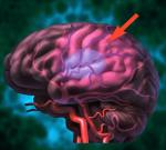 Нарушения функций мозга вследствие инсульта могут быть временными