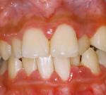 Стволовые клетки помогут вернуть выпавшие зубы