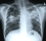 Туберкулез не сдается - атака на Великобританию