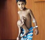 Мальчика с 8-ю конечностями избавили от родственника-паразита