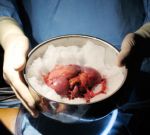 Новая драма в трансплантологии: двум реципиентам были пересажены почки от донора, больного агрессивной формой рака