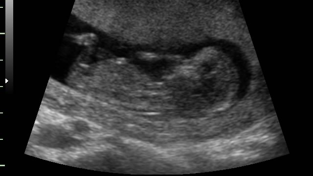 Ультразвуковое исследование на 12 неделе беременности