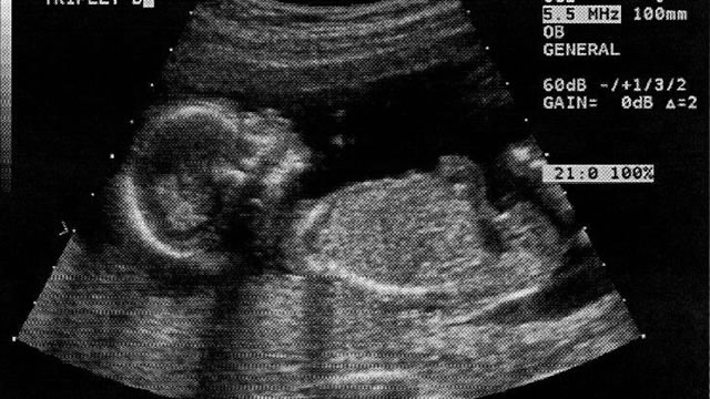 Ультразвуковое исследование на 20 неделе беременности