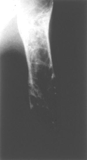 Деструкция плечевой кости при болезни Гоше
