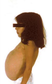 Ребенок 8 лет с болезнью Гоше (до лечения)