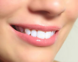 Отбеливание зубов – надежное средство для частых улыбок